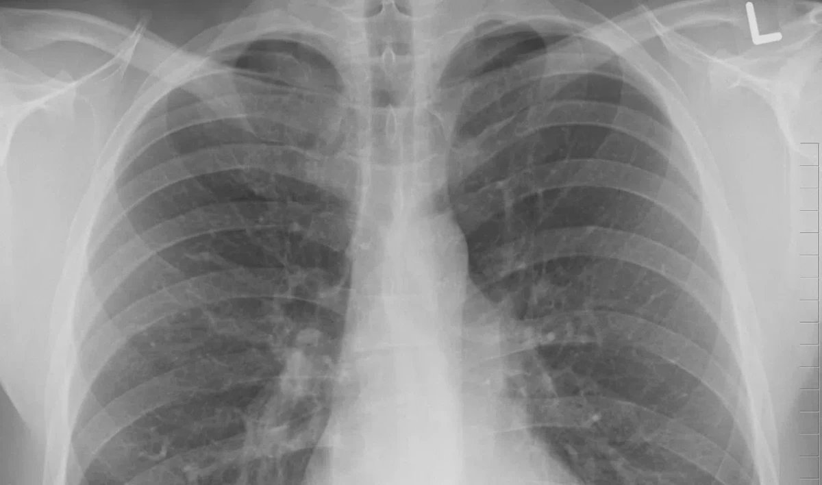 В Петербурге выявлено рекордное число пневмоний - tvspb.ru