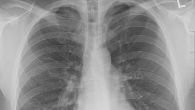 В Петербурге выявлено рекордное число пневмоний