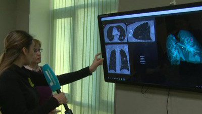 В петербургском Политехе создали интеллектуальную систему диагностики рака легких