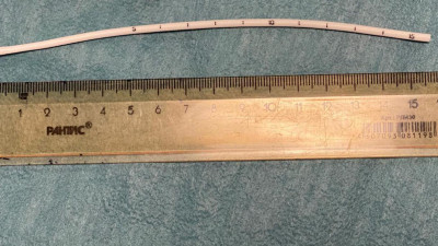 В Елизаветинской больнице 63-летней пациентке через вену достали оторвавшийся фрагмент катетера