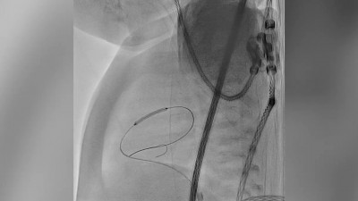 Врачи Педиатрического университета применили редкую методику лечения порока сердца