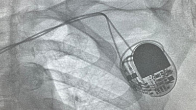 В Елизаветинской больнице впервые провели операцию по установке электрокардиостимулятора