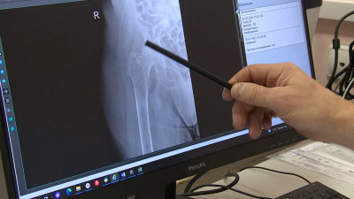 Опыт Госпиталя для ветеранов войн по лечению переломов у пожилых внедрят в больницах России