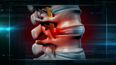 Чем грыжа диска отличается от протрузии и всегда ли нужна операция