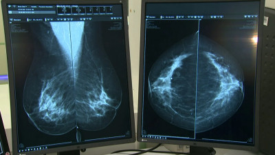 В ЛЭТИ нейросеть научили распознавать рак груди по рентгеновским снимкам