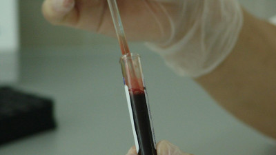 Применение плазмы при коронавирусе наиболее эффективно в первые 3-7 суток заболевания