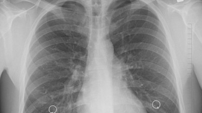Американские ученые нашли новый метод диагностики рака легких