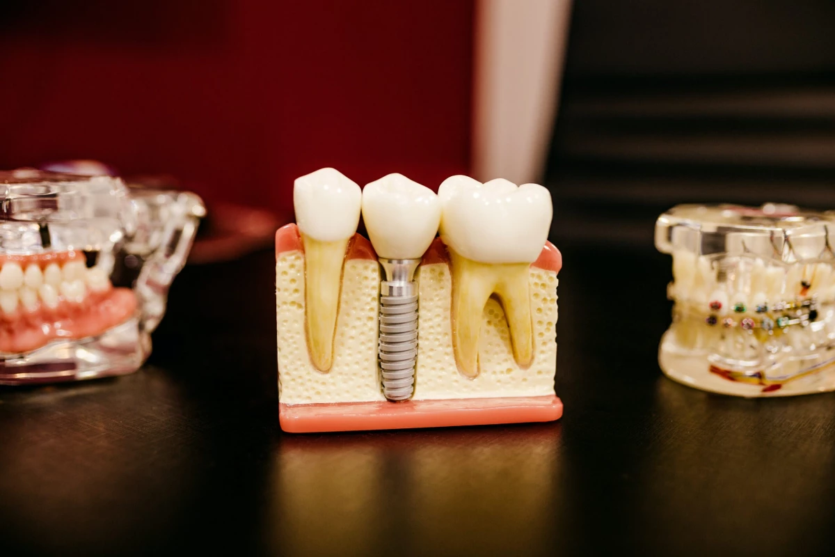Стоматолог Бирюков объяснил, нужно ли удалять зубы мудрости - tvspb.ru