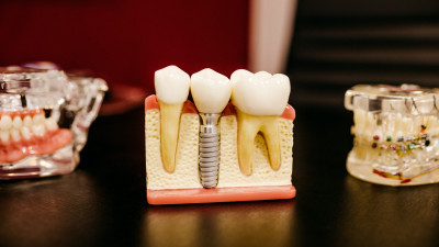 Стоматолог Бирюков объяснил, нужно ли удалять зубы мудрости