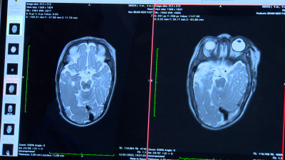 Петербургские нейрохирурги провели уникальную операцию на мозге младенца