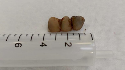 В НИИ Джанелидзе из бронхов пациентки достали зубной протез