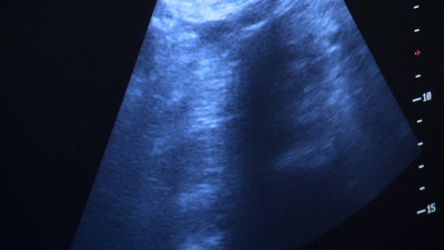 Уникальная операция в больнице Святителя Луки: врачи удалили кисту размером с футбольный мяч