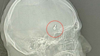 Хирурги НИИ имени Джанелидзе спасли мужчину с шурупом в голове