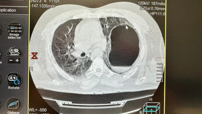 Мужчину со смещением органов после падения спасли в Истре