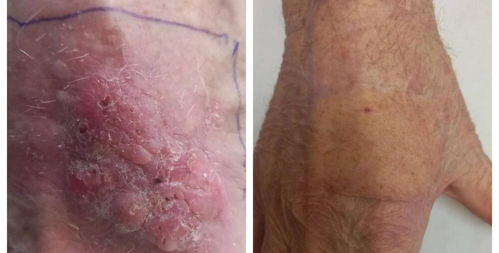 Успешную пересадку кожи на руке выполнили пациенту больницы в Черноголовке - tvspb.ru