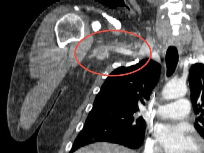 Мужчину с тромбом размером 25 сантиметров спасли в больнице - tvspb.ru