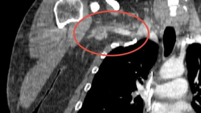 Мужчину с тромбом размером 25 сантиметров спасли в больнице