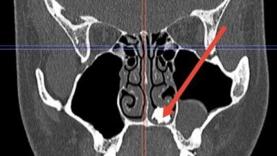 Покрытый грибком молочный зуб достали из носа 22-летнего пациента