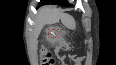 Пациента с распоротым рыбьей костью кишечником спасли в больнице