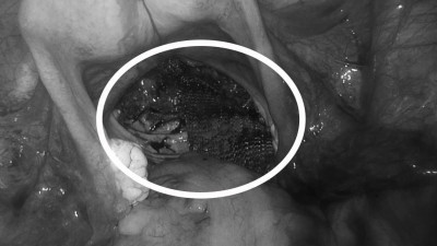 Женщину с осложнениями после травмы позвоночника спасли в больнице