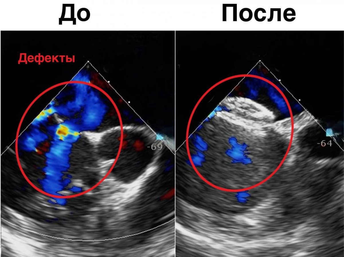 Ребенка с редкой аномалией сердца спасли в медцентре Рошаля - tvspb.ru
