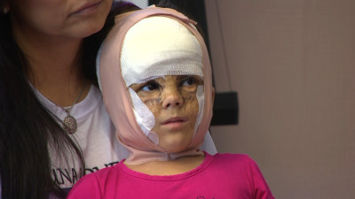 Девочке из США с «маской Бэтмена» провели вторую операцию в Петербурге