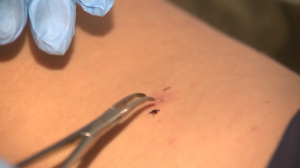 Первая помощь: что делать, когда обнаружили присосавшегося к вам клеща