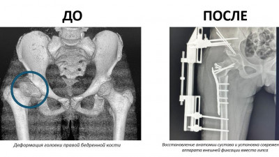 В медцентре Рошаля спасли девочку с некрозом бедренной кости