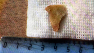 Врачи Елизаветинской больницы спасли 68-летнего мужчину, вытащив осколок говяжьей кости из его бронхов