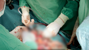 Операции по пересадке сердца в Мариинской больнице