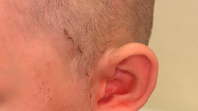 Петербургские врачи спасли ребенка с ЧМТ после падения с турника