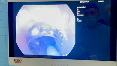 Не могла проглотить даже воду: в НИИ скорой помощи им. И.И. Джанелидзе помогли пациентке с редкой патологией пищевода