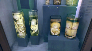 Про «уродцев» и людей. Куда пропала анатомическая коллекция Кунсткамеры?