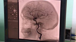 Инсульт: причины, первые симптомы и обязательные действия первого часа