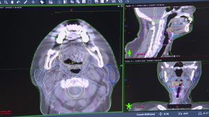 Лечение онкологических заболеваний. Лучевая терапия