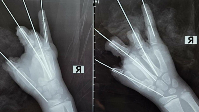 Собирали кисть по сантиметру: в СПбГПМУ прооперировали ребёнка, у которого в руке взорвалась петарда