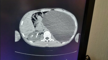 Осмотр перед трудоустройством спас жизнь подростка в Новосибирске, у которого выросла почка с пятилитровую бутылку