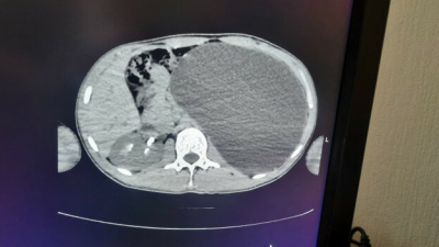 Осмотр перед трудоустройством спас жизнь подростка в Новосибирске, у которого выросла почка с пятилитровую бутылку