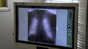 Мобильная флюорографическая диагностика