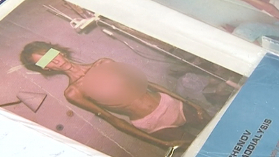 Торчащие рёбра и отказ от еды: как соцсети толкают подростков к опасной худобе