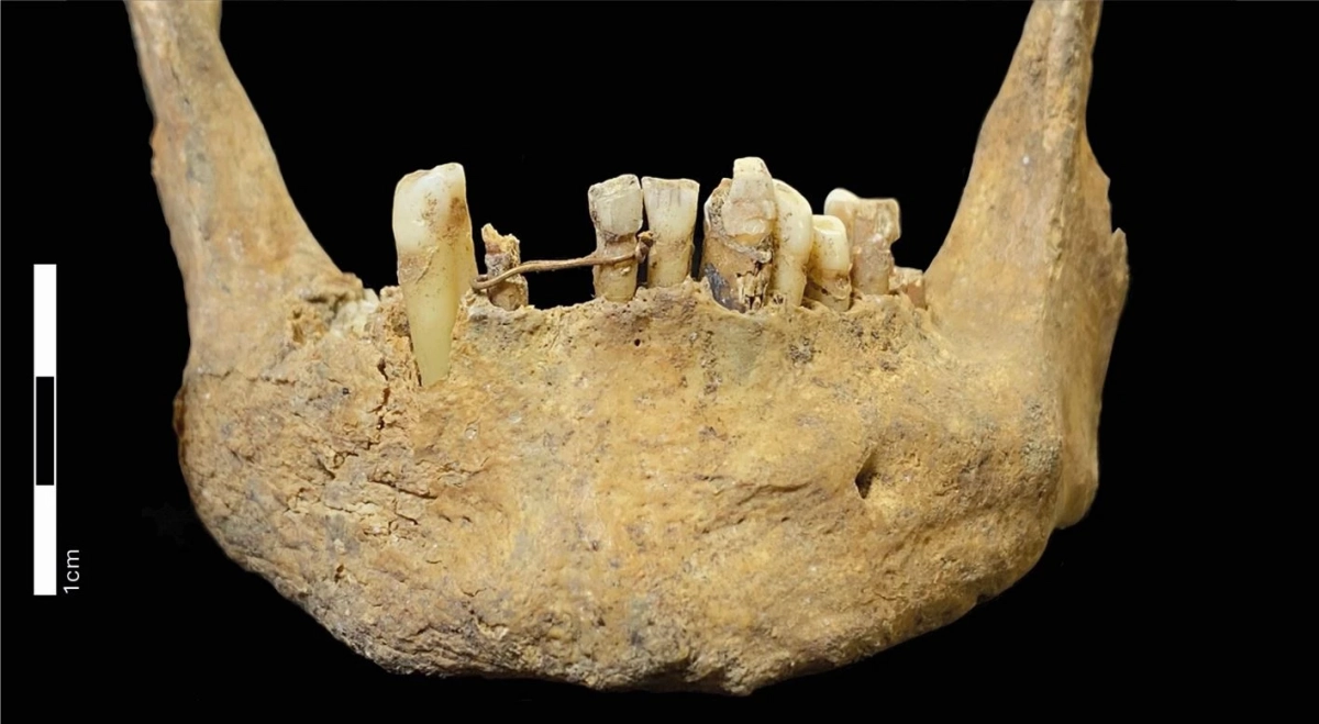 За сотни лет до дантистов: в Шотландии нашли средневековую челюсть с золотым мостом - tvspb.ru