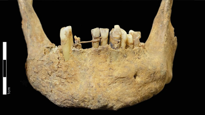 За сотни лет до дантистов: в Шотландии нашли средневековую челюсть с золотым мостом